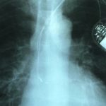 Some Medical Devices Have Been Recalled Without Any Public Warning